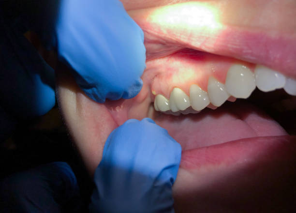 Best Emergency Wisdom Teeth Removal in Lisbon Falls, ME